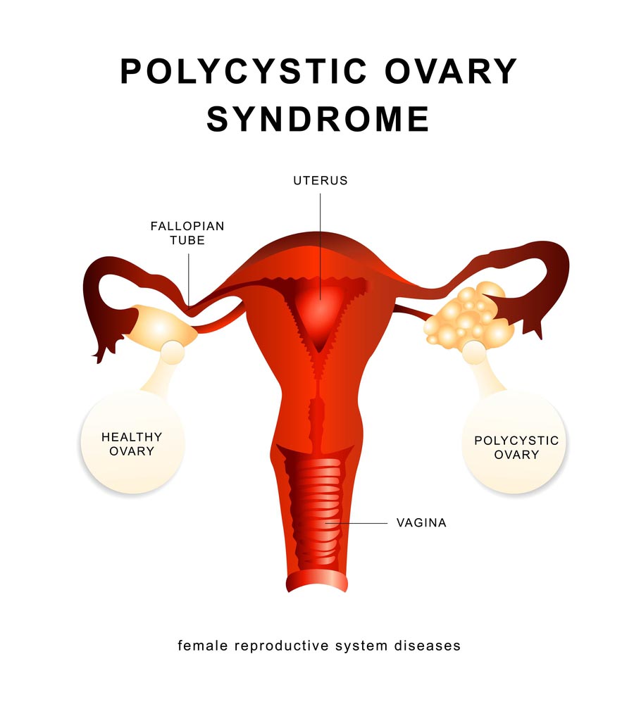 SOPK, syndrome ovaires polykystiques, symptomes SOPK, traitement SOPK, ovaires polykystiques grossesse, alimentation SOPK