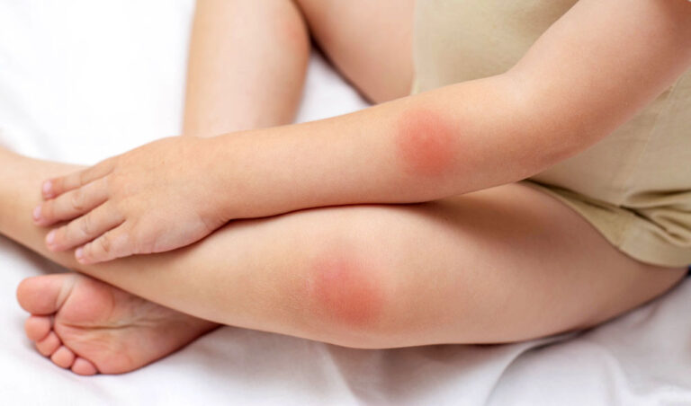 Intertrigo du bébé : comprendre, prévenir et soigner cette dermatose des plis